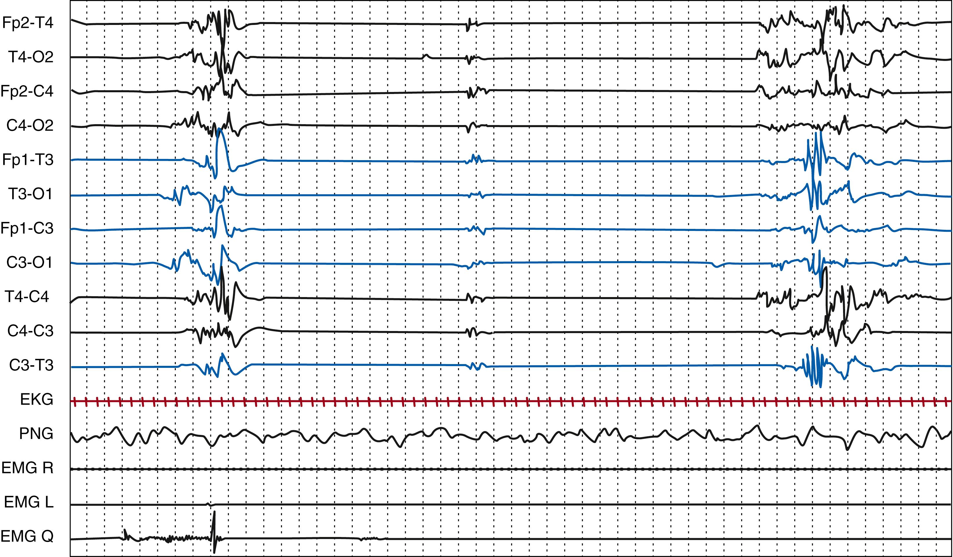 Fig. 130.7, Preterm newborn born at 24 weeks postmenstrual age (PMA), recorded at 4 weeks of age (28 weeks PMA). Interburst intervals of 9 and 12 seconds, respectively. Polygraphic electroencephalography recording (EKG, PNG: pneumogram; EMG R: right deltoid; EMG L: left deltoid; EMG Q: quadriceps). Gain, 30 μV/mm; high frequency filter, 70 Hz; paper speed, 120 mm/s.