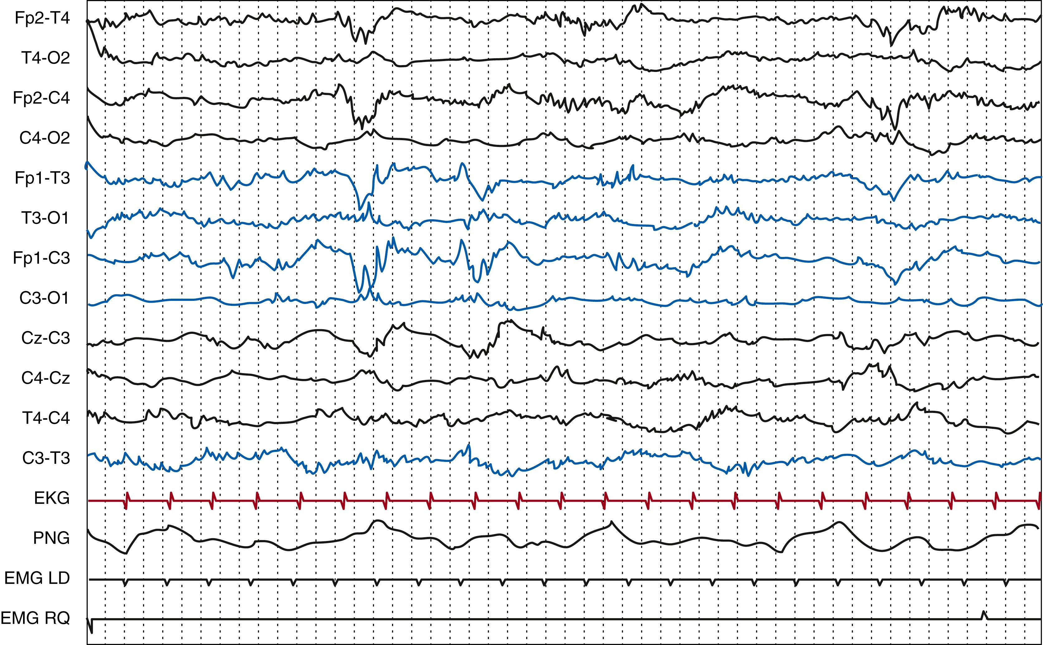 Fig. 130.8, Preterm newborn, 32 weeks gestational age. Active sleep. Continuous tracing with abundant bilateral delta brushes. Polygraphic electroencephalography recording (EKG, PNG: pneumogram, EMG LD: left deltoid; EMG RQ: right quadriceps). Gain, 15 μV/mm; high frequency filter, 70 Hz; paper speed, 30 mm/s.