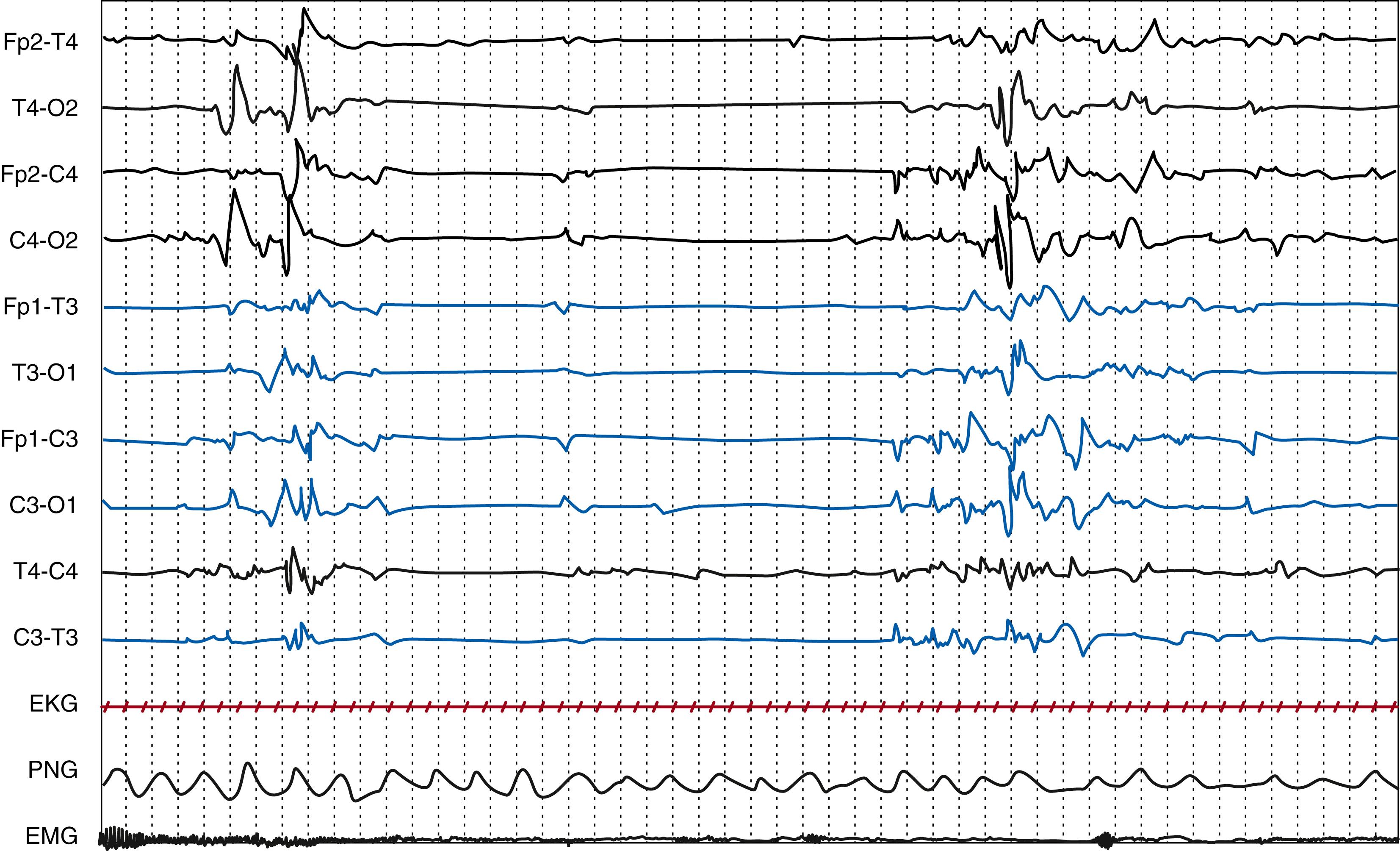 Fig. 130.9, Indeterminate state, recorded at 2 weeks of age (27 weeks postmenstrual age) in a preterm neonate born at 25 weeks. Polygraphic electroencephalography recording (EMG of the right upper limb, EKG, and PNG). Discontinuous tracing. Bursts of high-voltage delta waves with superimposed fast rhythms are separated by interburst interval of 19 seconds. Gain, 15 μV/mm; high frequency filter, 70 Hz; paper speed, 120 mm/s.