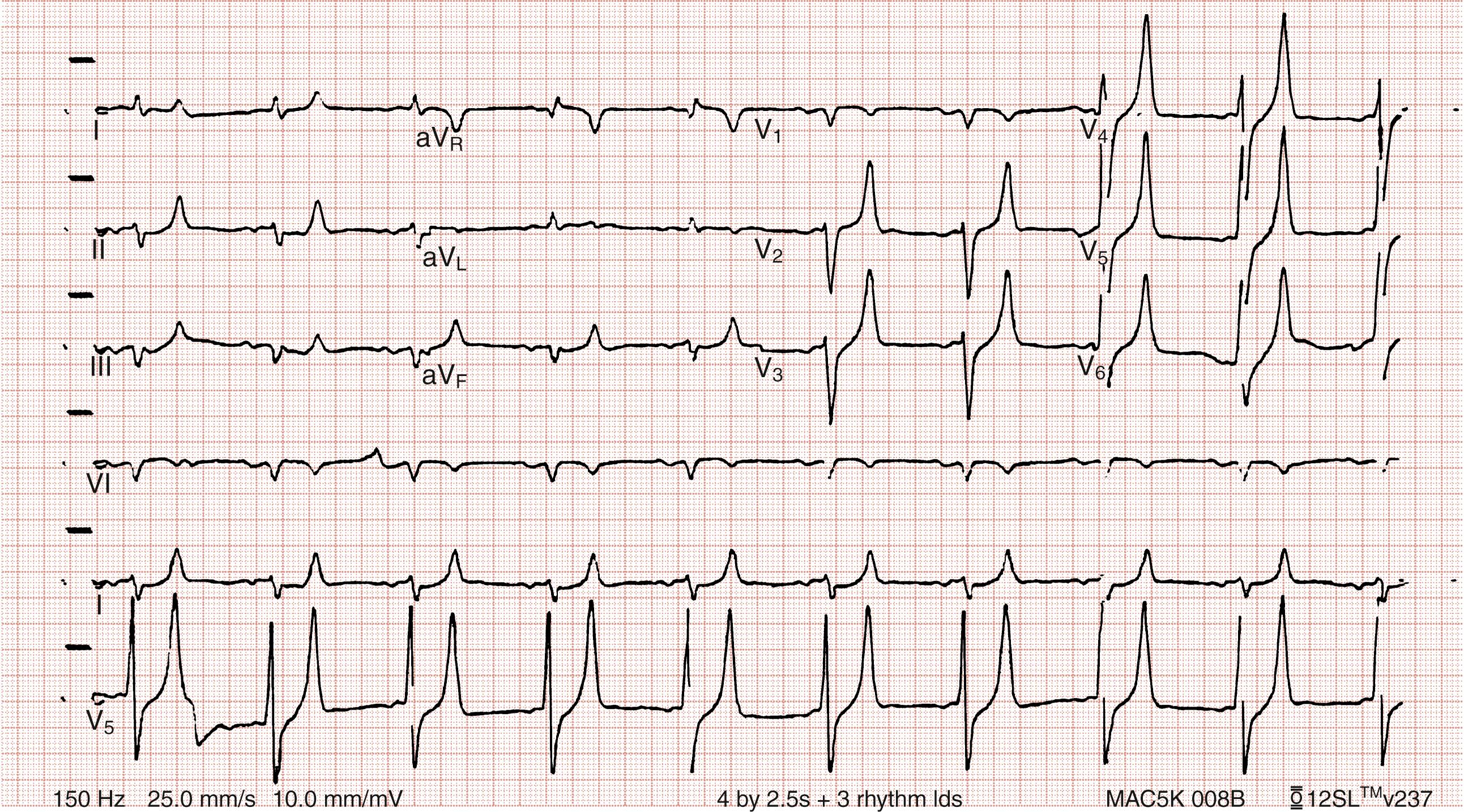 Fig. 114.2, Hyperkalemia in the same patient as in Figure 114.1 after potassium-lowering therapy has begun. Tall peaked T waves, decreased P wave.