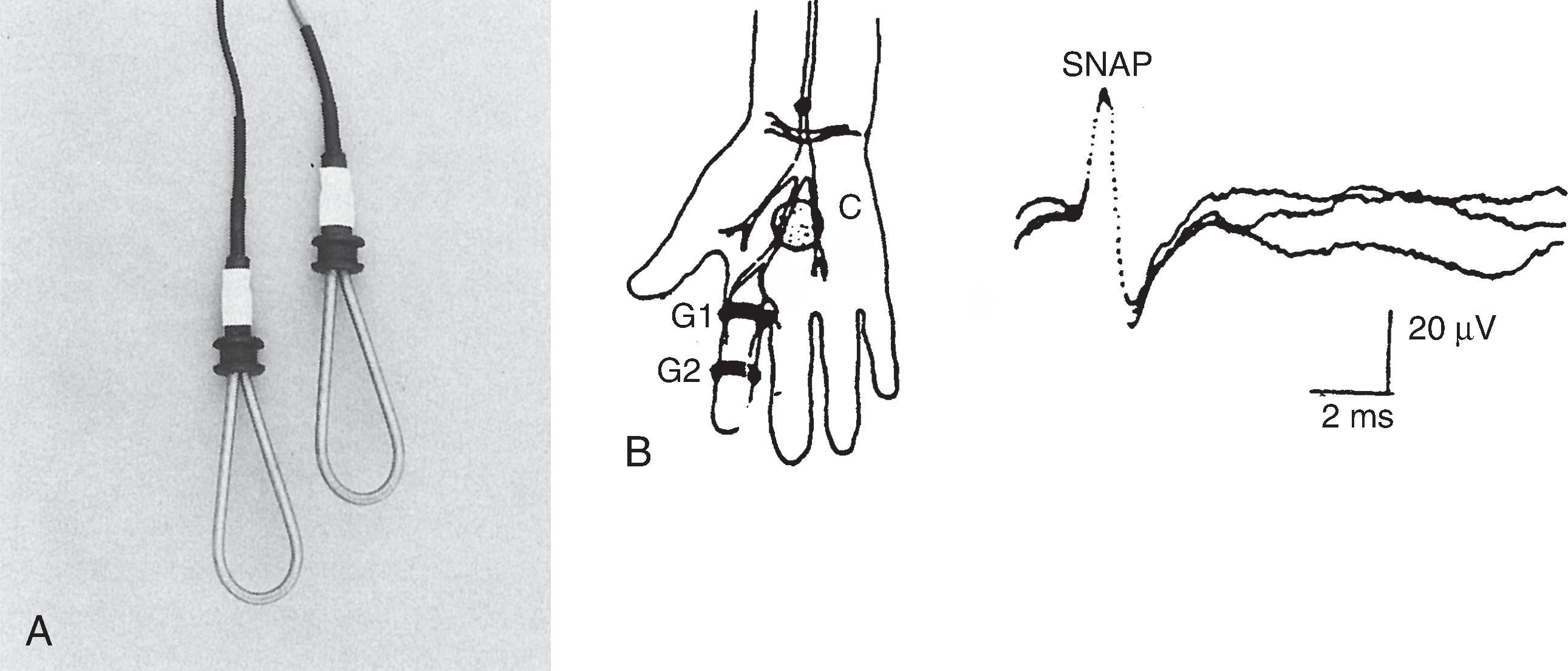 Figure 19.1, A , Commonly used ring electrodes for measurement of median and ulnar sensory nerve conduction studies. B, Placement of electrodes for median sensory nerve conduction studies and sensory nerve action potentials obtained on stimulation of the median nerve at the wrist. C, Ground electrode; G1, recording electrode; G2, reference electrode. ( A, Courtesy of Oxford Instruments Medical, Inc., Hawthorne, NY.)