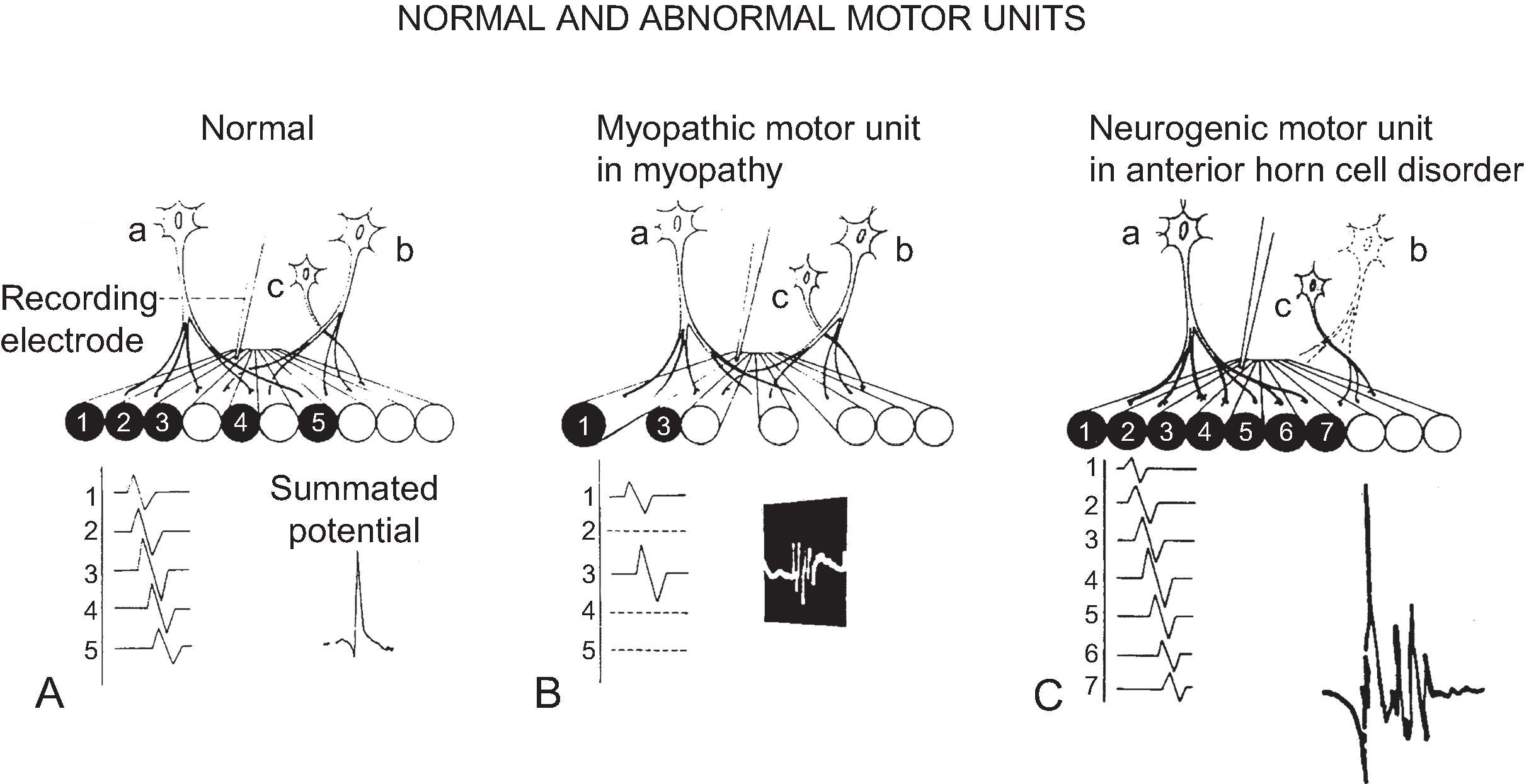 Figure 19.2, A, Schematic illustration of three normal motor units, “a,” “b,” and “c.” Note: Muscle fibers of different motor units are normally intermingled. Below the motor units are action potentials of five individual muscle fibers of a motor unit and its summated motor unit potential. B, Myopathic changes in motor unit “a.” Of the original five muscle fibers, three have undergone degeneration, thus reducing the size of the motor unit. C, Neurogenic transformation of motor unit “a.” Anterior horn cell “b” is shown undergoing degeneration, and its two muscle fibers are not innervated by axons of anterior horn cell “a,” thus leading to an increase in the territory and size of motor unit “a.”