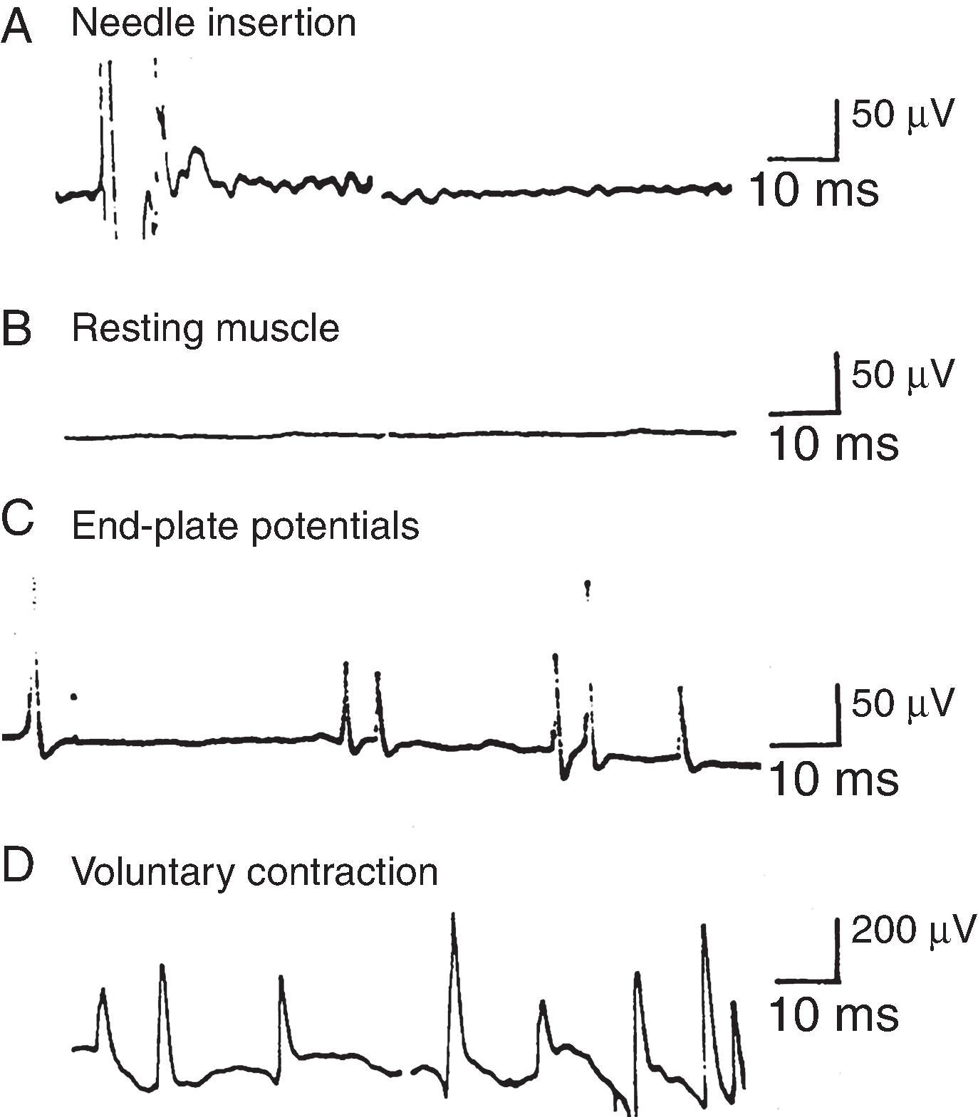 Figure 19.3, A, Trace showing normal insertional activity. B, No spontaneous activity in a normal muscle at rest. C, Spontaneous endplate potentials. D, Normal biphasic and triphasic motor unit potentials during weak voluntary contraction.