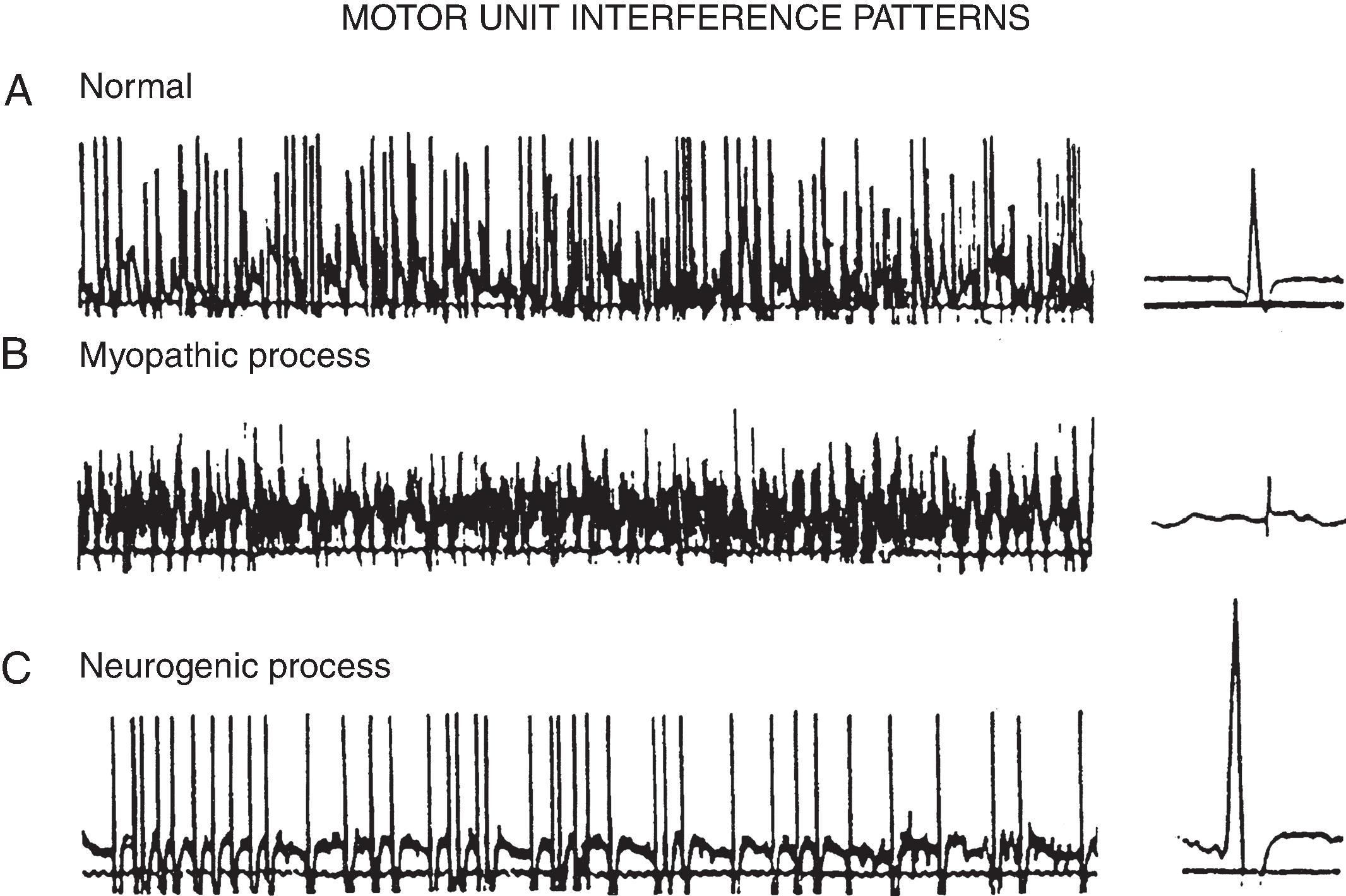 Figure 19.4, A, Full interference pattern on maximum effort in a normal muscle. B, Full interference pattern in a myopathic muscle on sub-maximal effort. The number of spikes is greater (each spike represents a motor unit) because of an increase in the firing rate of motor units with early recruitment. C, Reduced interference pattern in a denervated muscle on maximal effort resulting from loss of motor units. Note: The decreased number of spikes is evident by an increased gap between spikes.