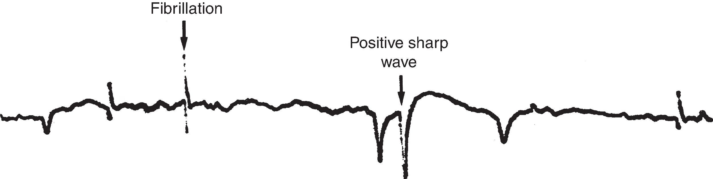 Figure 19.5, Positive sharp wave and fibrillation potentials recorded from a denervated muscle.