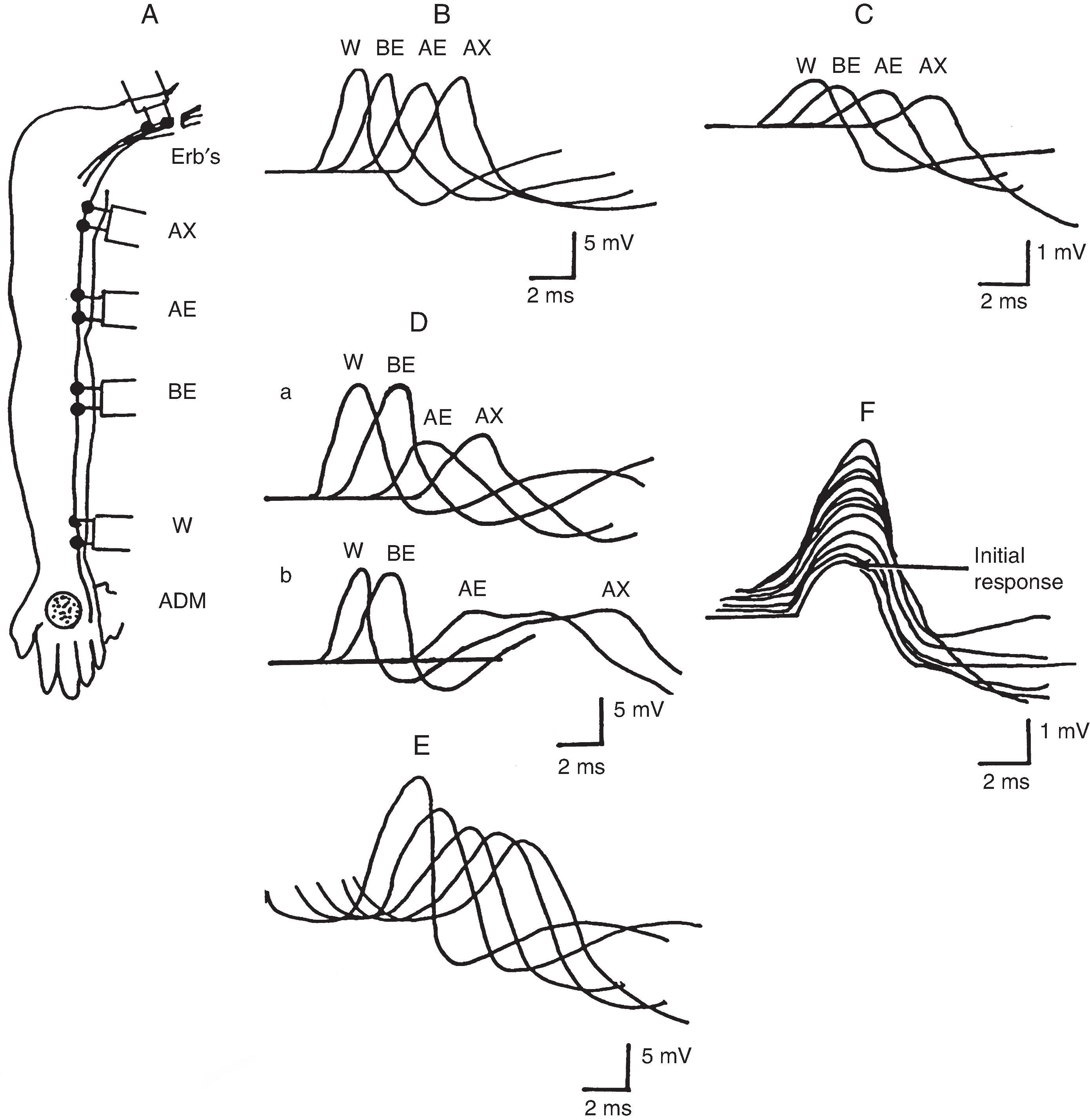 Figure 19.7, A, Commonly used site of stimulation of the ulnar nerve at the wrist, below the elbow, above the elbow, and at the axilla. The ulnar nerve can also be stimulated at Erb’s point in the supraclavicular fossa. B, Normal amplitude compound motor action potentials (CMAPs) recorded from the abductor digiti minimi manus following stimulation of the ulnar nerve at these various sites. C, Low amplitude CMAPs in a patient with axonal neuropathy. All CMAPs are of the same amplitude but are much smaller than normal. D, Decremental response (a) and decremental and dispersed response (b) on stimulation above the elbow and at the axilla and normal response on stimulation below the elbow and wrist. E, Repetitive nerve stimulation of the ulnar nerve at the wrist in a patient with myasthenia gravis. Note the initial normal response and subsequent decremental response at the slow rate (3 pulses/s). F, Repetitive nerve stimulation in Lambert-Eaton syndrome. With a rapid rate (20–50 pulses/s), a marked incremental response occurs. Note the very low initial response and the two-fold to four-fold increase following the rapid rate of stimulation. AE , Above the elbow; AX , axilla; BE , below the elbow; W , wrist.