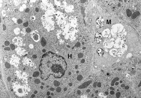 Fig. 17.2, Liver tissue from a patient with Niemann–Pick disease.