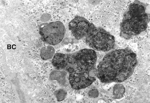 Fig. 17.3, Dubin–Johnson syndrome.