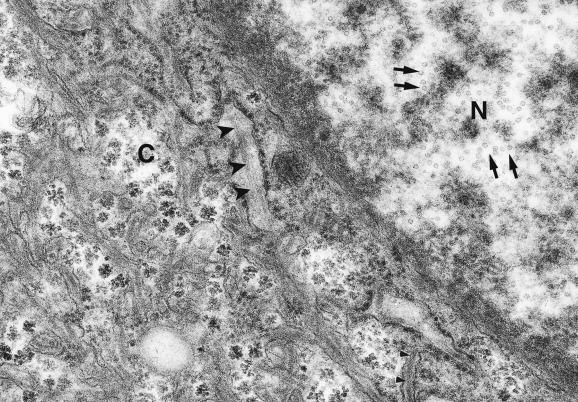 Fig. 17.7, Hepatocyte in hepatitis B surface material (HBsAg)-positive chronic hepatitis.