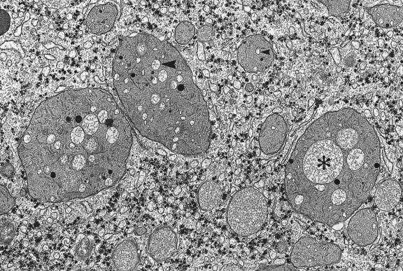 Fig. 17.8, Wilson’s disease.