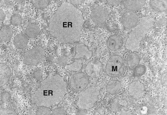 Fig. 17.10, Alpha 1 -Antitrypsin deficiency.