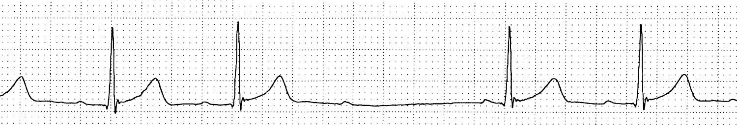 Fig. 22.1, Rhythm strip demonstrating Mobitz I atrioventricular block (Wenckebach pattern); PR prolongation with a dropped ventricular beat. The PP interval is constant.