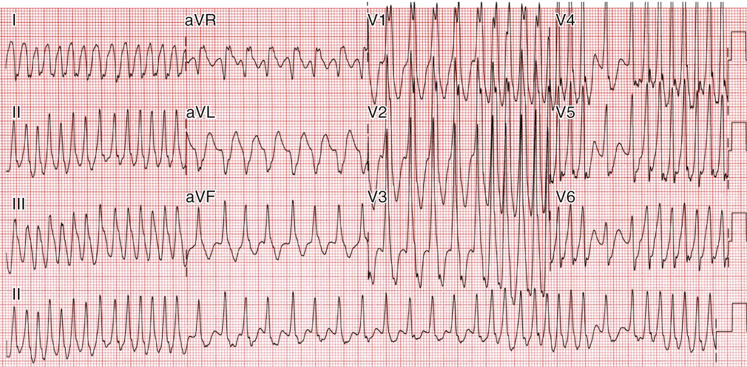 Fig. 22.11, A 12-lead electrocardiogram (ECG) demonstrating a wide complex irregular rhythm in a patient with known ventricular preexcitation who presented with a syncopal event that was triggered by complaints about a rapid heartbeat. The patient was cardioverted to normal sinus (preexcited) rhythm and subsequently underwent catheter ablation fo the manifest accessory pathway. This ECG is consistent with preexcited atrial fibrillation.