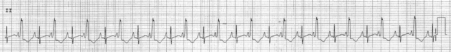 Fig. 22.12, Rhythm strip demonstrating an intermittent Wolff-Parkinson-White pattern. Every other beat appears to be preexcited, with a delta wave and alternating beats showing a normal sinus (normal PR interval) rhythm. This patient still had supraventricular tachycardia, as the retrograde limb of the circuit allowed for ventriculoatrial conduction and the propagation of reentrant supraventricular tachycardia.