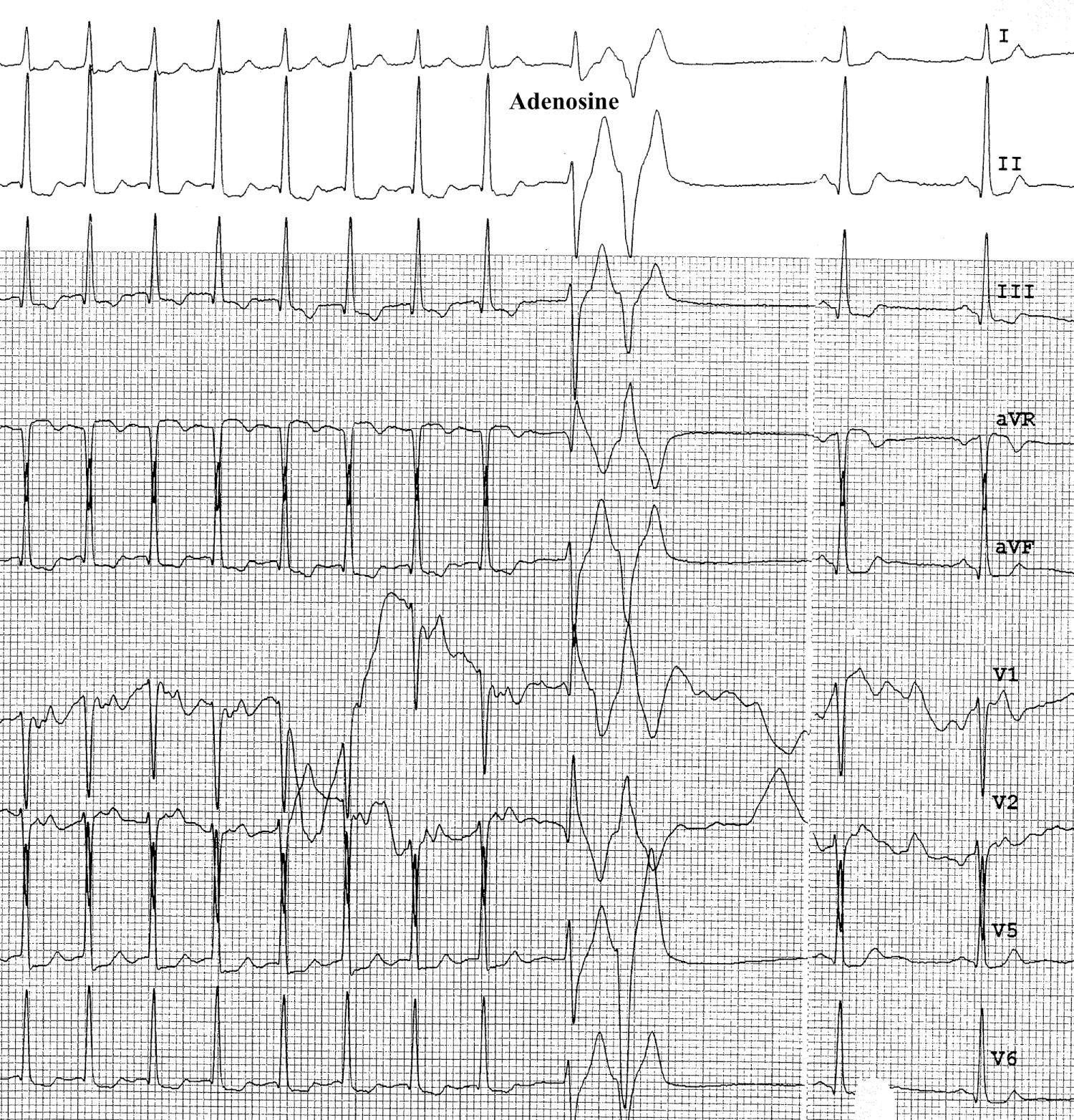 Fig. 22.13, Combined limb and chest leads showing a narrow complex tachycardia in this 15-year-old patient who presented to the emergency department complaining of palpitations. The tracings show a narrow complex supraventricular tachycardia at 182 beats/min, which terminated with intravenous adenosine to a normal sinus (nonpreexcited) rhythm.