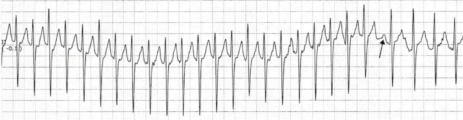 Fig. 22.14, Rhythm strip from a 4-month-old with a narrow complex supraventricular tachycardia (SVT) breaking through on flecainide and propranolol. The rate of the SVT is 190 beats/min. The tachycardia broke as an intravenous line was being placed. The arrow shows the first sinus beat. The abrupt termination of the SVT is consistent with a reentrant type of arrhythmia.