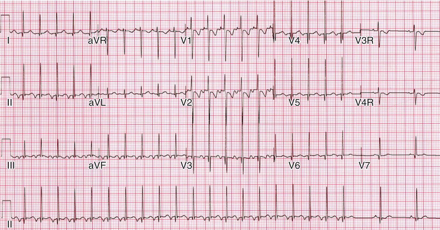 Fig. 22.15, Run of permanent junctional reciprocating tachycardia with a typical long RP interval and retrograde atrial activation, which breaks to sinus on the second-to-last beat of the tracing.