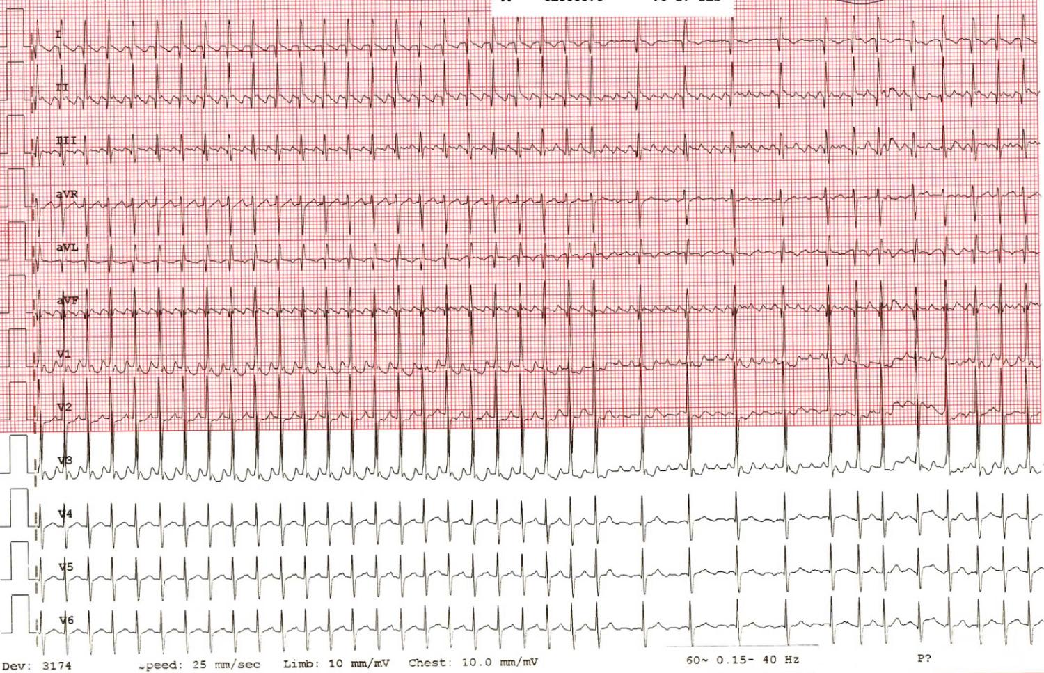 Fig. 22.16, A 12-lead rhythm strip showing a narrow complex tachycardia in a 12-hour-old baby. The sawtooth pattern of atrial flutter becomes even more manifest with transient atrioventricular nodal block.