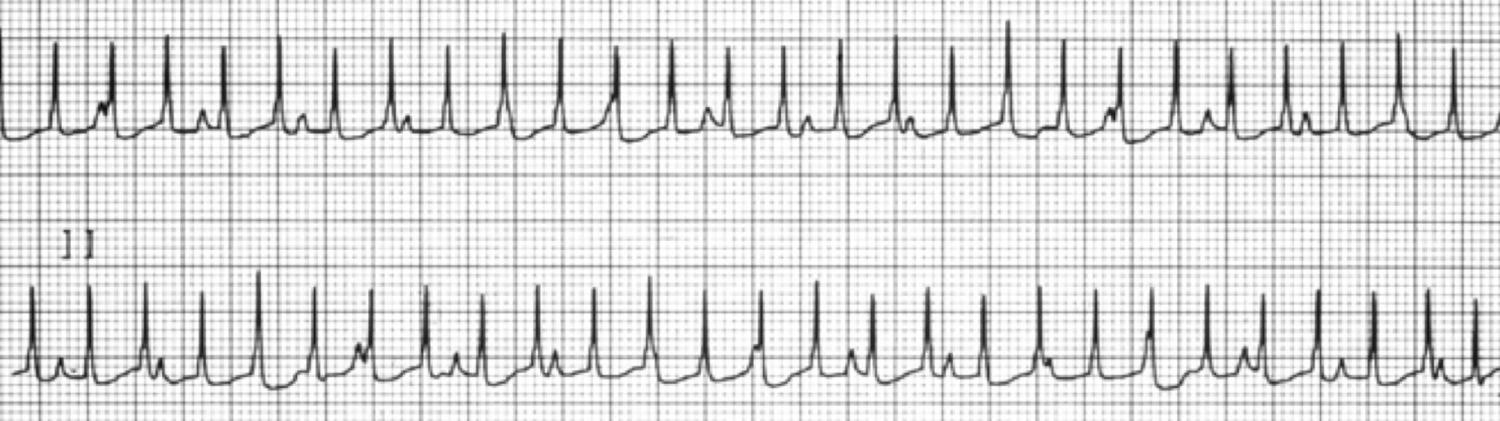 Fig. 22.17, Rhythm strips showing a narrow complex tachycardia in a 4-month-old following repair of tetralogy of Fallot with pulmonary atresia who had a prior BT shunt. The atrial wave pressure tracing had cannon A waves. The rhythm strips demonstrate atrioventricular dissociation with the RR interval faster (shorter cycle length) than the PP interval. A combination of intravenous amiodarone along with atrial pacing faster than the junctional rhythm restored atrioventricular synchrony and the cannon A waves resolved.