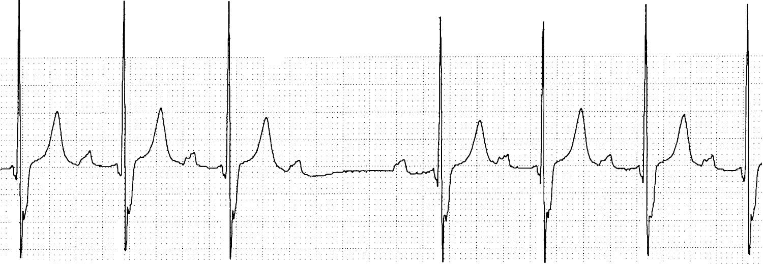 Fig. 22.2, Rhythm strip demonstrating Mobitz type II atrioventricular block. There is baseline first-degree atrioventricular block and a wide QRS complex. The PR interval after failure of atrioventricular conduction is identical to the preblock PR interval. This patient had syncope in the postoperative period after implantation of a prosthetic mitral valve. A pacemaker was subsequently placed.