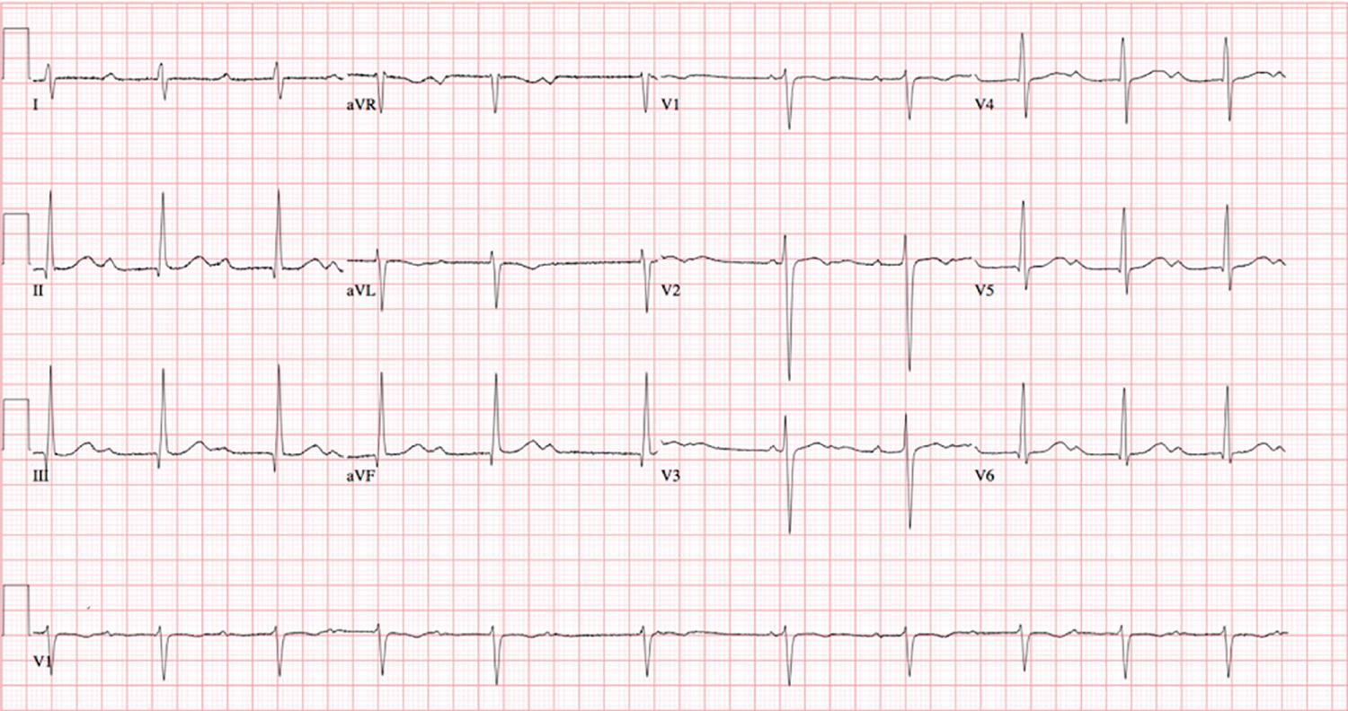 Fig. 22.3, A 12-lead electrocardiogram showing progressive PR prolongation with a narrow QRS complex. Mobitz type II atrioventricular block. The rhythm strip at the bottom portion shows a normal PR interval and eventually a dropped beat. The pattern of “grouped beating” is a frequent observation in patients with Mobitz I atrioventricular block.