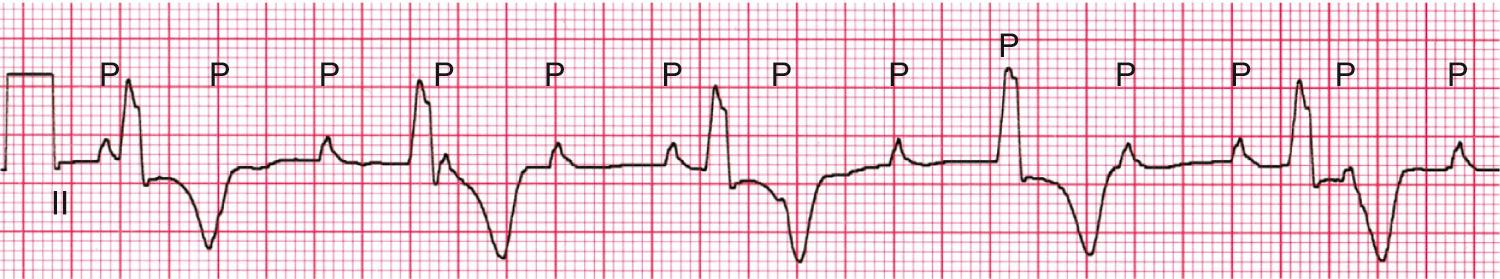 Fig. 22.4, Complete atrioventricular block. The atrial rate is 135 beats/min. The ventricular rate is 50 beats/min. The P waves bear no relationship to the QRS complexes, which are regular. The QRS complex is wide, which in this patient with congenital complete heart block is an indication for antibradycardia pacing.