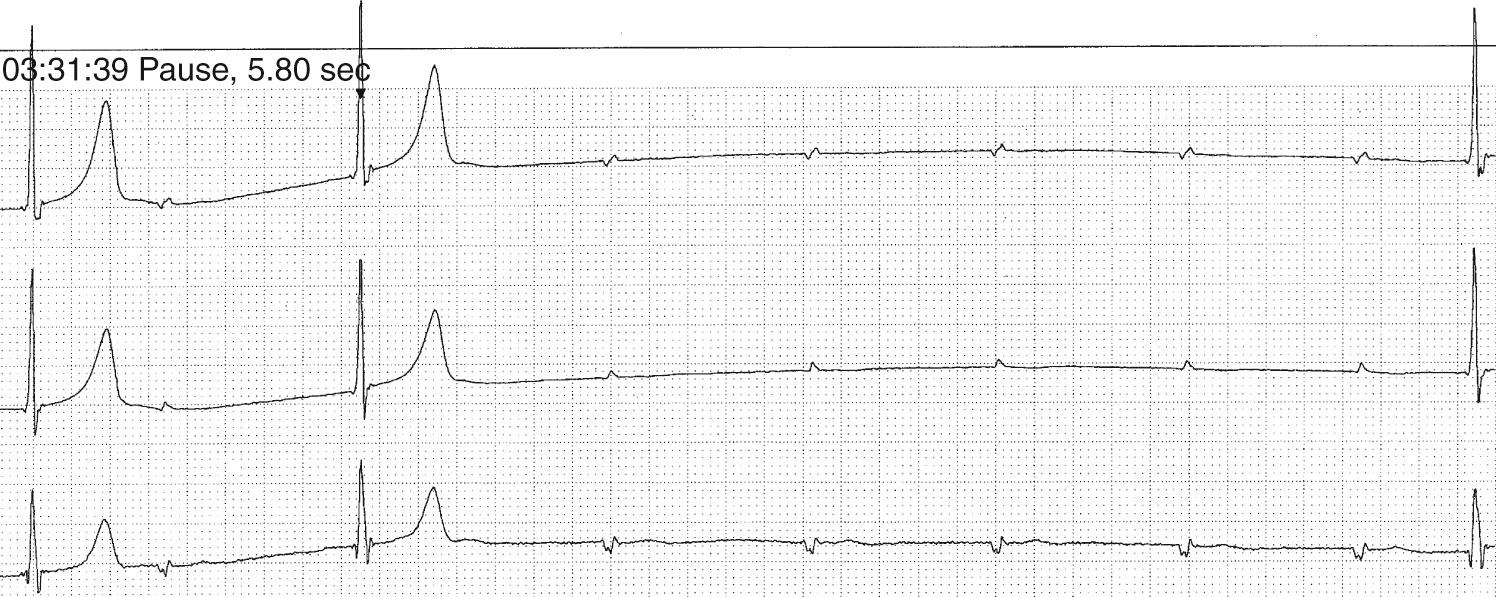 Fig. 22.5, A significant pause of 5.8 seconds was recorded overnight in a 10-year-old patient with congenital complete heart block. The pause length is not a multiple of the previous RR interval, so it is not of the type referred to by class IIa, recommendation 2. The presence of multiple pauses like this, however, led to insertion of an antibradycardia pacemaker.
