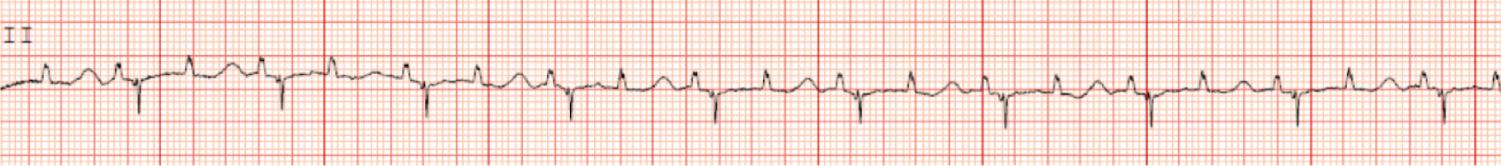 Fig. 22.6, Rhythm strip demonstrating functional 2 : 1 atrioventricular block in the presence of QT prolongation (prolonged ventricular refractoriness).