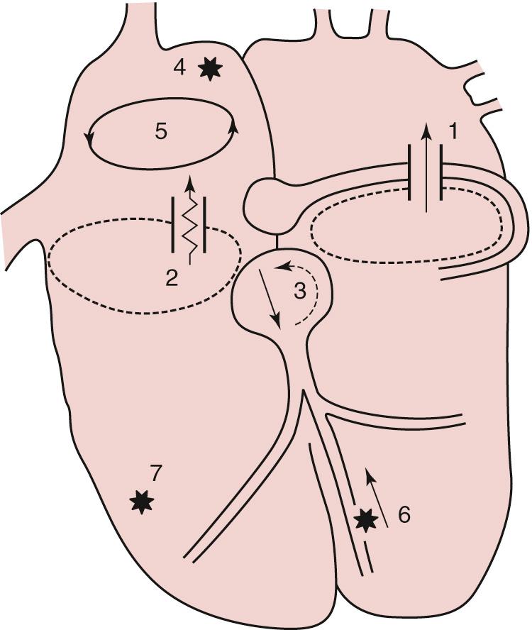 Fig. 22.7, Substrates for supraventricular tachyarrhythmias that may be amenable to ablation (1 to 5): unidirectional concealed accessory pathway; (2) slowly conducting accessory pathway, such as permanent junctional reciprocating tachycardia; (3) atrioventricular nodal reentrant tachycardia; (4) focal atrial tachycardia; (5) intraatrial reentrant tachycardia. Substrates for ventricular arrhythmias that may represent ablation foci include (6) fascicular tachycardia and (7) ventricular tachycardias.