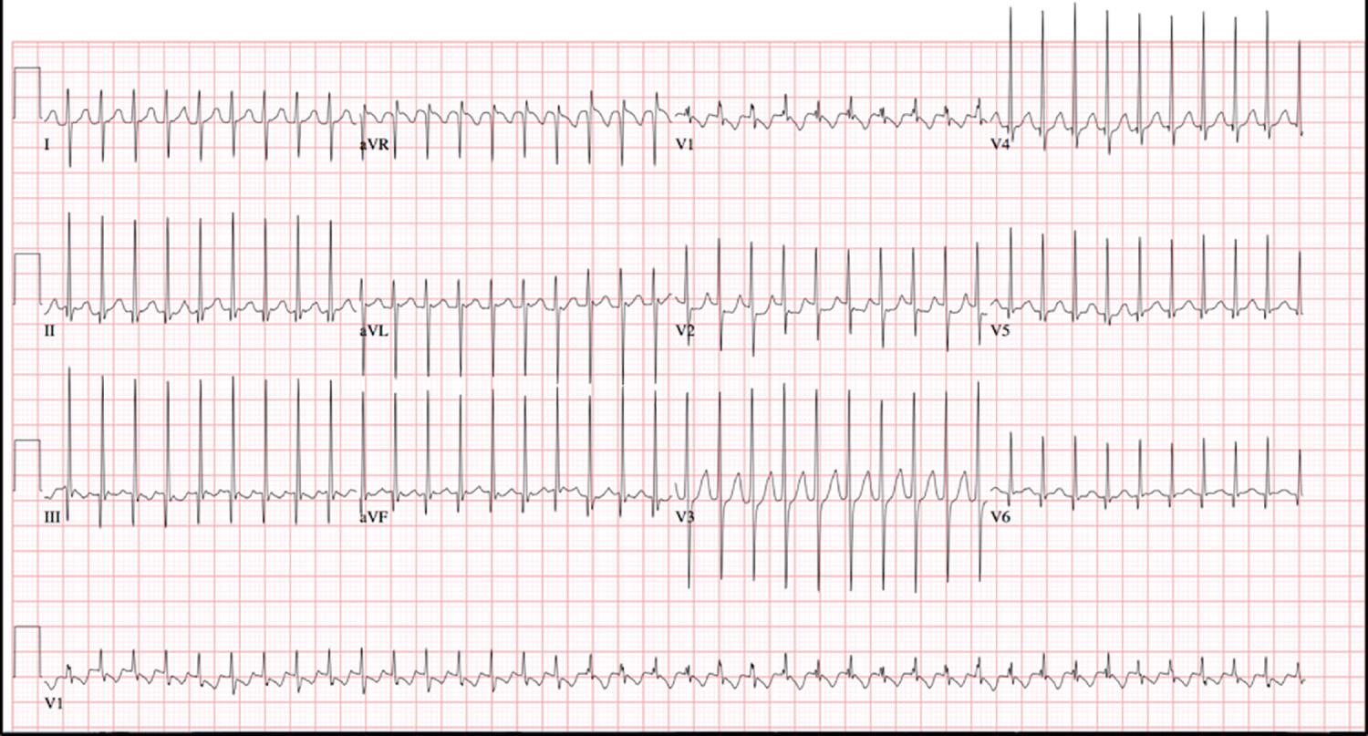 Fig. 22.8, A 12-lead electrocardiogram demonstrating short RP′ narrow complex supraventricular tachycardia with a normal QRS axis.