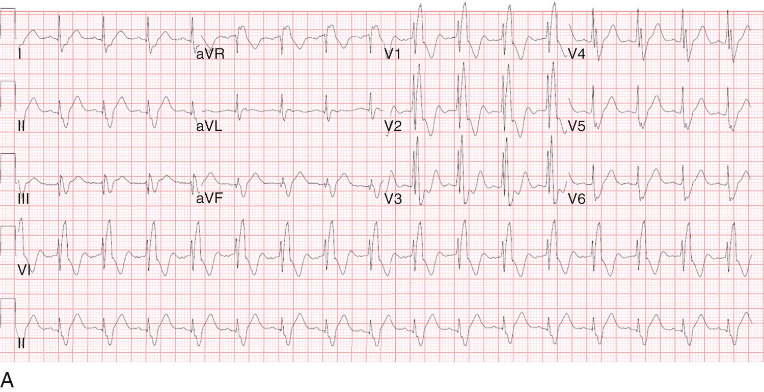 Fig. 22.9, (A) A 22-year-old patient with tetralogy of Fallot underwent repair and subsequent transcatheter pulmonary valve baseline electrocardiography that showed sinus rhythm and right-bundle-branch block with a QRS duration of 200 ms. The same patient (B) presenting with a wide complex tachycardia with an identical QRS morphology in all leads and no evidence of atrioventricular dissociation. This electrocardiogram represents atrial tachycardia with an underlying right-bundle-branch block.