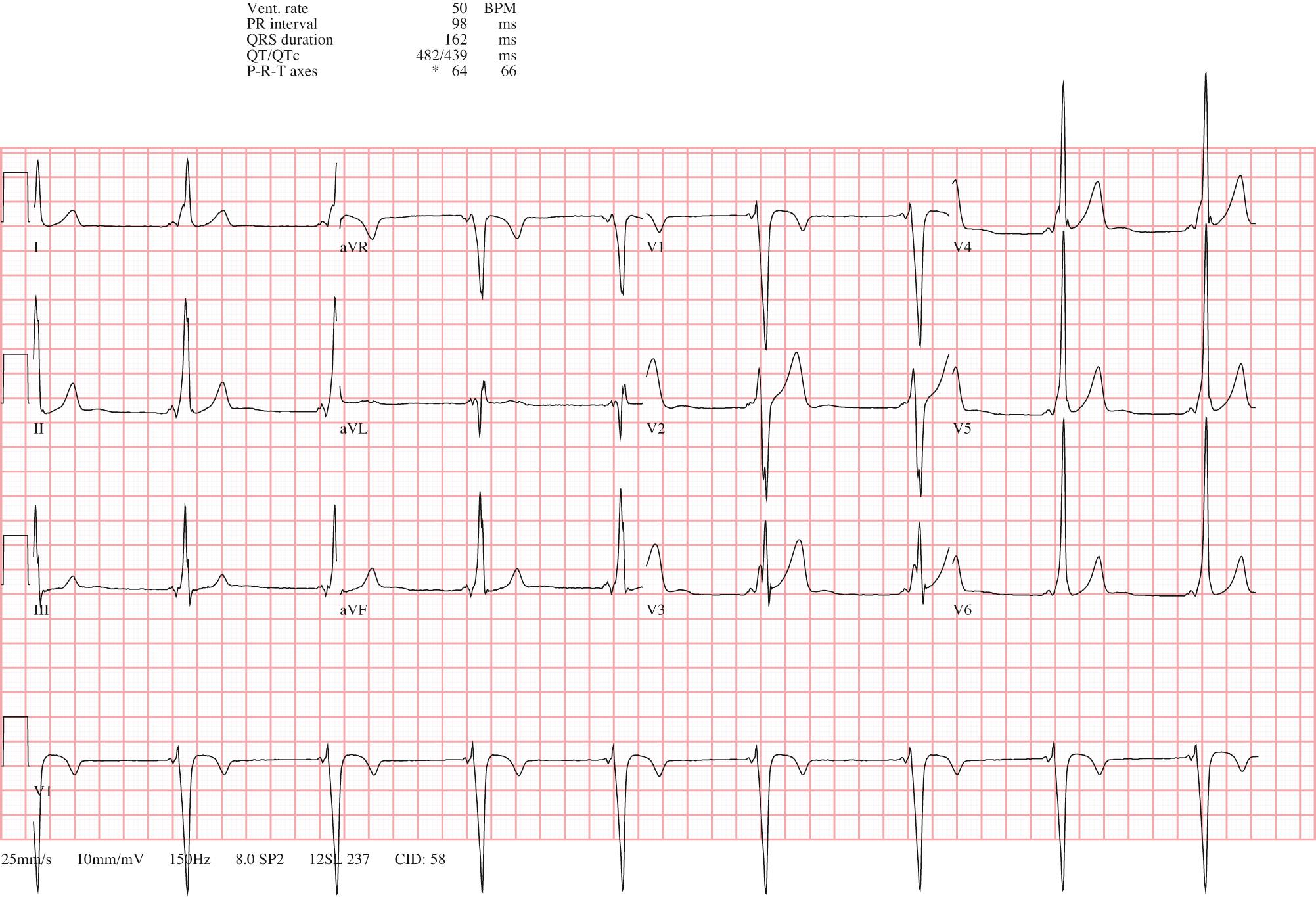 Fig. 22.10, A 12-lead electrocardiogram demonstrating ventricular preexcitation consistent with a Wolff-Parkinson-White pattern.