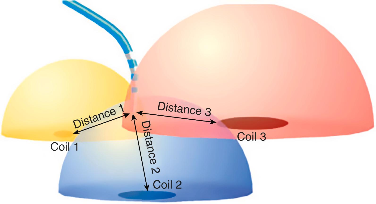 Figure 24.5, Electroanatomical mapping in the electrophysiology laboratory. The three hemispheres are fields created from three different electromagnets beneath the patient. An element within the catheter tip is sensed by these fields and enables monitoring of location and orientation of the catheter tip.