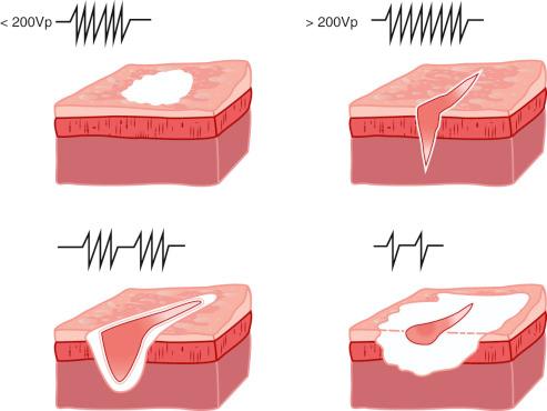 FIG 6.4, Different waveforms produce different tissue effects.