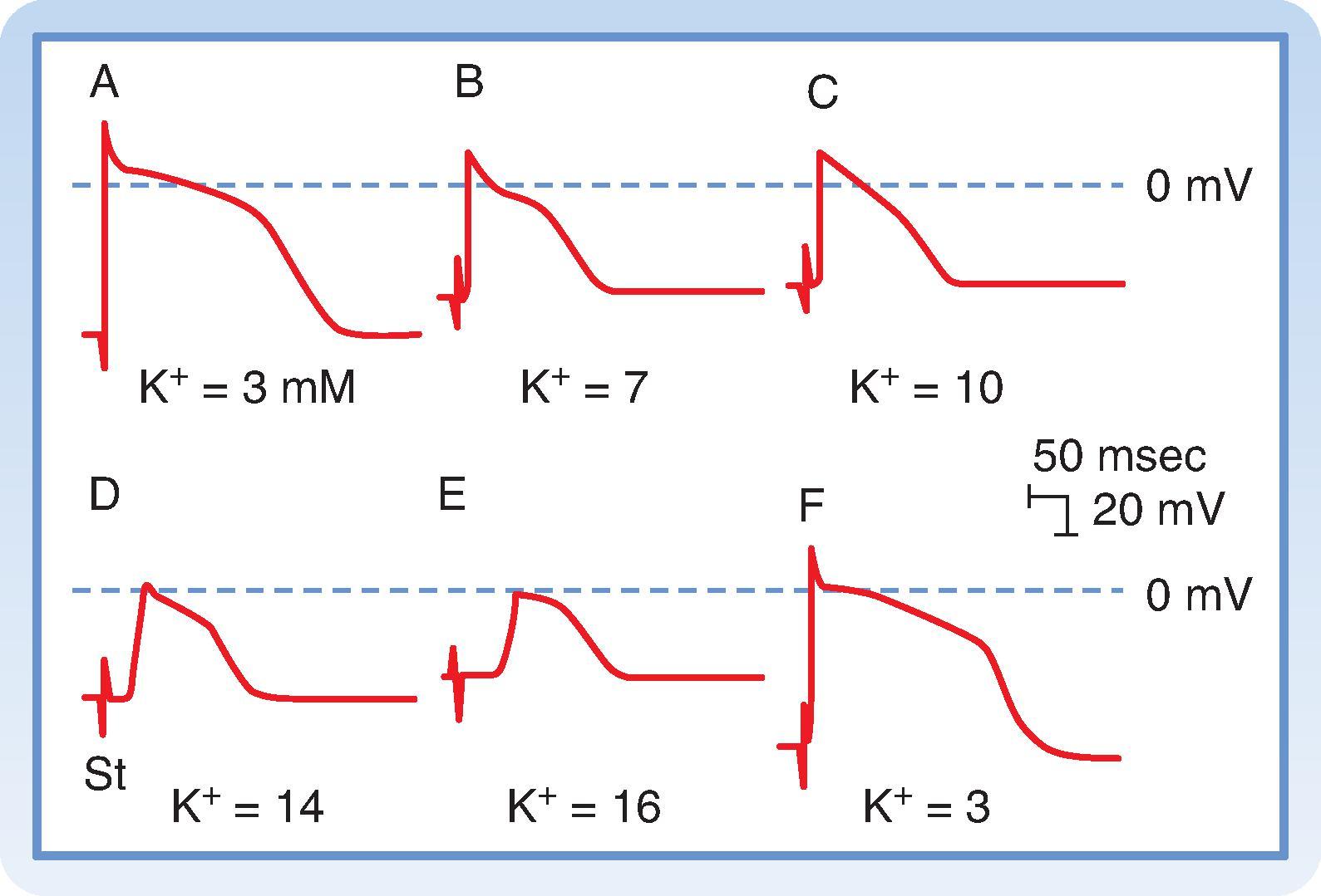 Fig. 16.10, Effect of changes in extracellular [K + ] on action potentials recorded from a Purkinje fiber. The stimulus artifact (St in tracing D) appears as a biphasic spike to the left of the upstroke of the action potential. The horizontal dashed lines near the peaks of the action potentials denote 0 mV. When extracellular [K + ] is 3 mM (tracings A and F), the resting membrane potential (V M ) is −82 mV, and the slope of phase 0 is steep. At the end of phase 0, the overshoot attains a value of +30 mV. Hence, the action potential amplitude is 112 mV. The distance from the stimulus artifact to the beginning of phase 0 is inversely proportional to the conduction velocity. When extracellular [K + ] is increased gradually to 16 mM (tracings B to E), resting V M becomes progressively less negative. At the same time, the amplitude and duration of the action potential and the steepness of the upstroke all diminish. As a consequence, conduction velocity decreases progressively. At extracellular [K + ] levels of 14 and 16 mM (tracings D and E), the resting V M attains levels sufficient to inactivate all the fast sodium channels and leads to the characteristic slow-response action potentials.