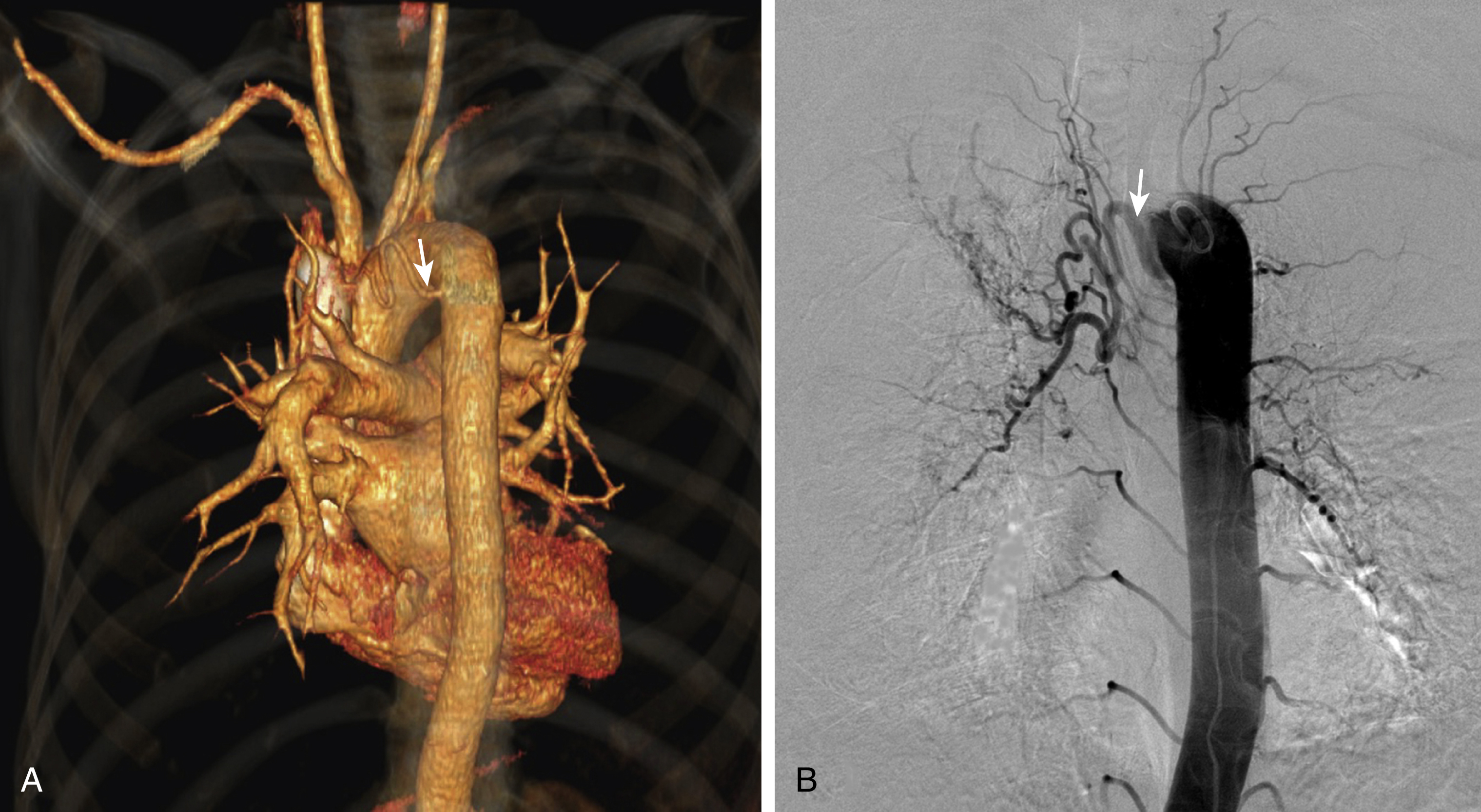 Fig. 53.5, (A) Computed tomography angiography 3D volumetric reconstruction of a patient with hemoptysis. Note the right bronchial artery ( arrow ).(B) Descending aortogram in the same patient demonstrating the same right bronchial artery ( arrow ).