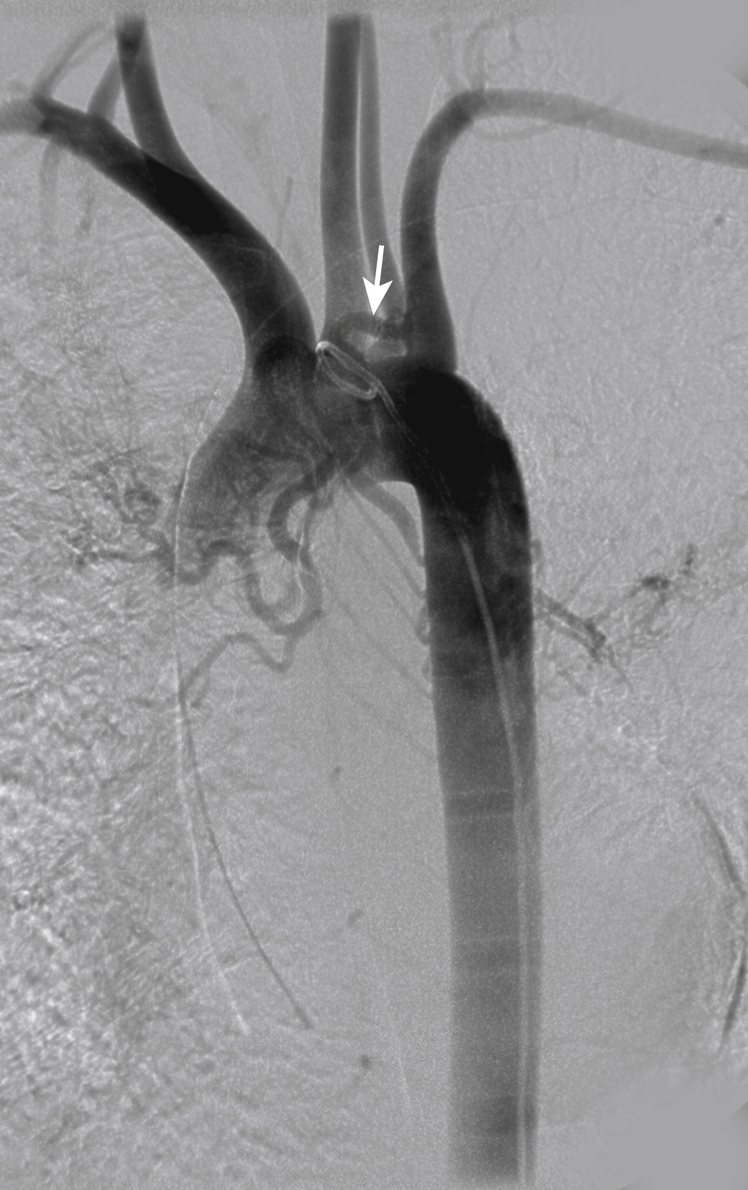 Fig. 53.6, Aberrant right bronchial artery that originates from the left subclavian artery ( arrow ).