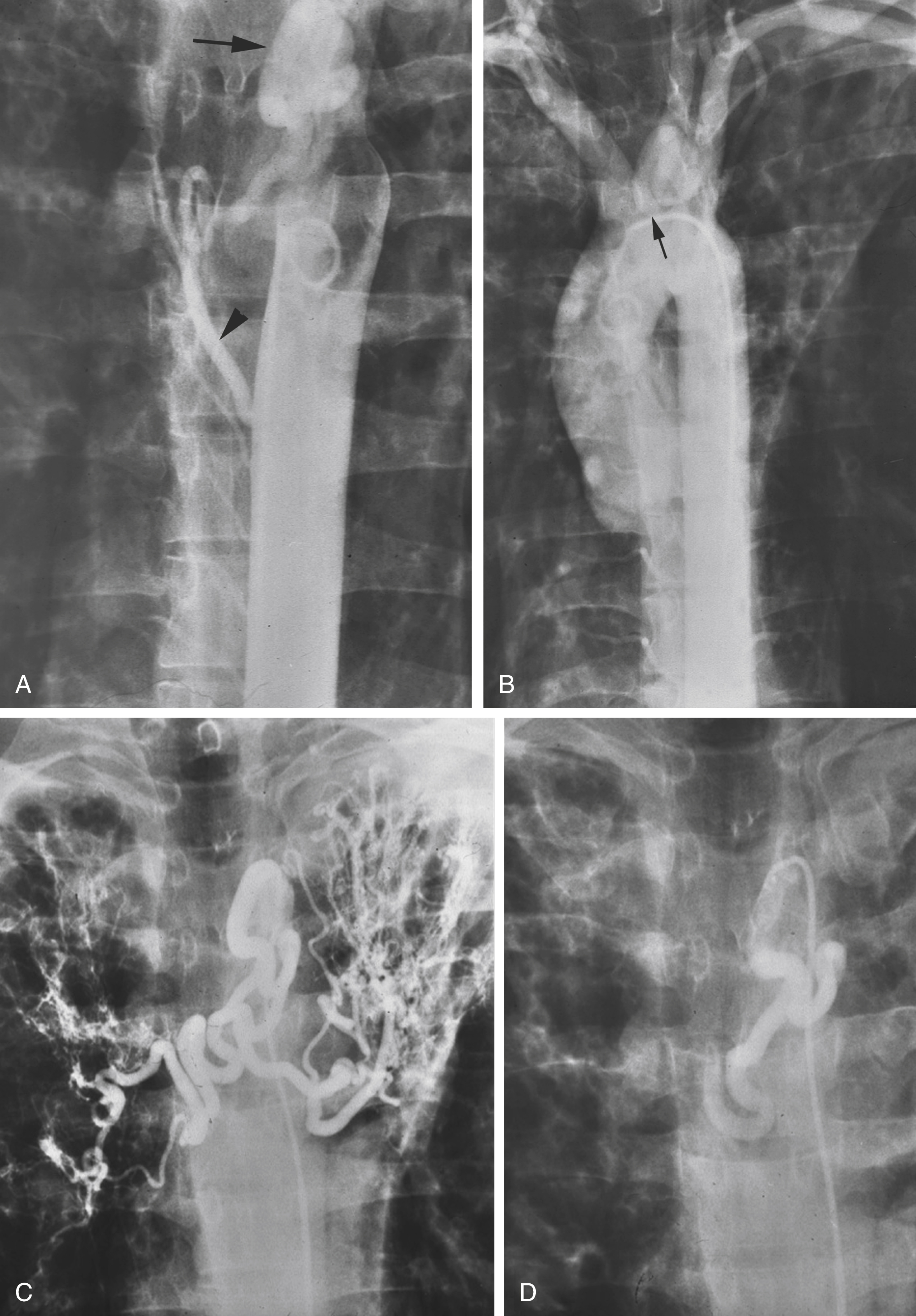 Fig. 53.7, A 41-year-old patient with massive hemoptysis from cystic fibrosis. (A) Descending aortogram reveals a moderately enlarged right bronchial artery ( arrowhead ) and an abnormal vascular structure at the level of the aortic arch ( arrow ). (B) A second aortogram with the pigtail catheter advanced around the aortic arch demonstrates the origin of the aberrant bronchial artery from the convex portion of the aortic arch between the innominate and left carotid arteries ( arrow ). Selective arteriograms of the aberrant bronchial before (C) and after (D) embolization.