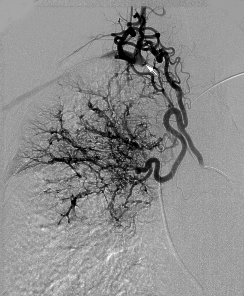 Fig. 53.8, This right bronchial arteriogram demonstrates filling of the innominate ( arrow ) and right common carotid arteries through collaterals.