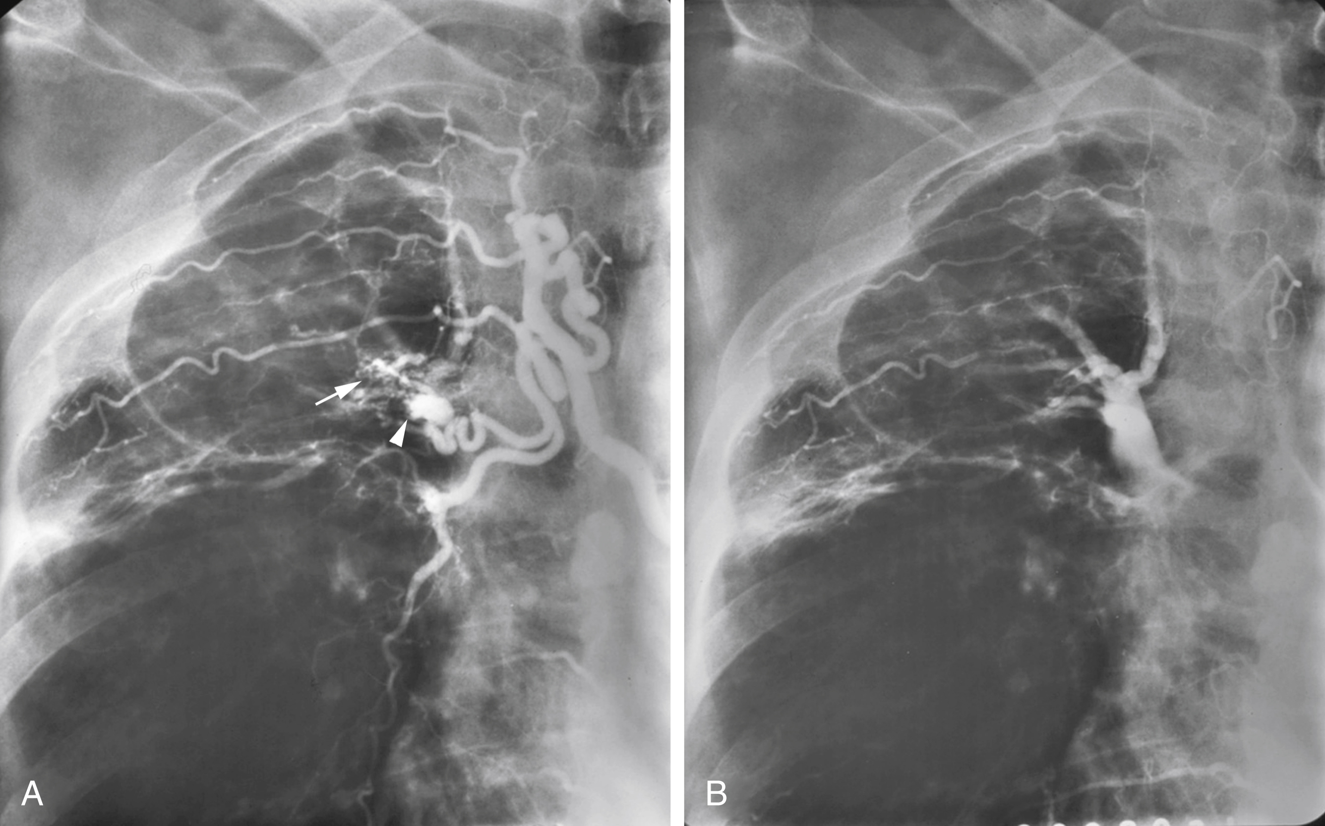 Fig. 53.9, Early (A) and late (B) phases of an angiogram on a patient with massive hemoptysis. (A) Early phase reveals an enlarged supreme intercostal-bronchial trunk with the bronchial portion supplying a small area of hypervascular lung ( arrow ) and a bronchial artery aneurysm ( arrowhead ). (B) Late phase of angiogram demonstrates shunting into the pulmonary artery from a supreme intercostal-bronchial trunk injection.