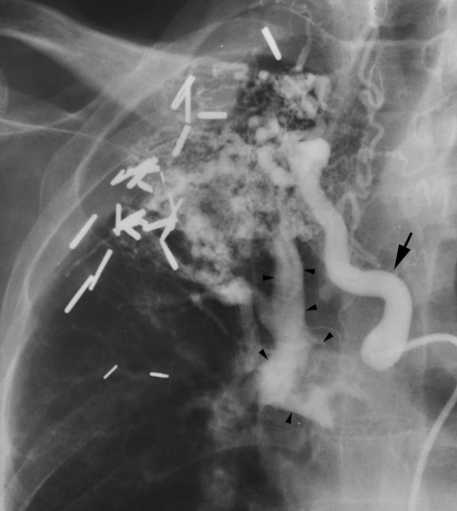 Fig. 53.10, Massively enlarged right bronchial artery ( arrow ) supplying hypervascular lung tissue with rapid shunting into a pulmonary artery ( arrowheads ).