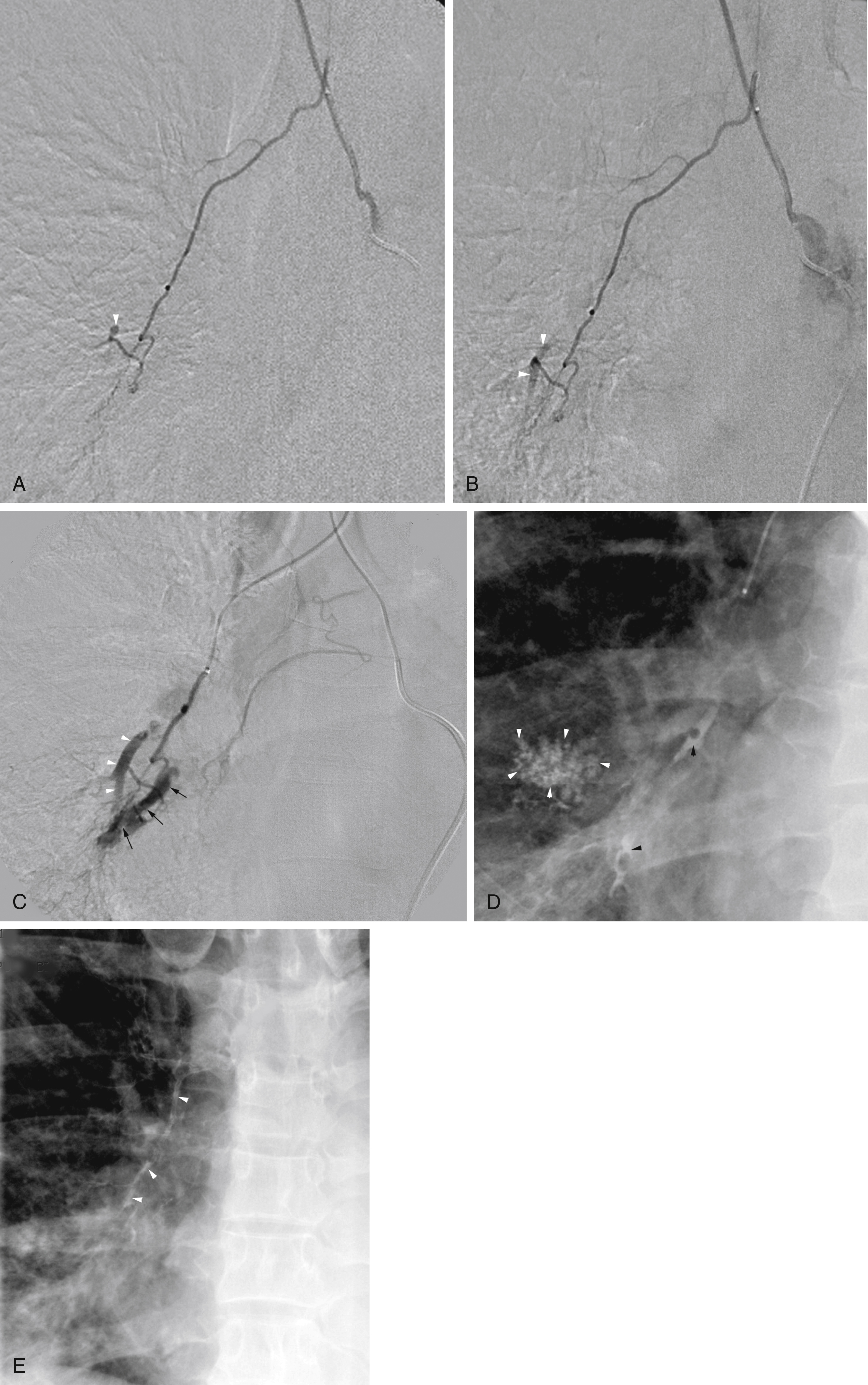 Fig. 53.11, Initial bronchial arteriogram in a young woman with intermittent hemoptysis. (A) A small bronchial artery aneurysm is present ( arrowhead ). (B) Repeated bronchial angiography demonstrates some bronchial to pulmonary artery shunting at the site of the aneurysm ( arrowheads ). (C) Bronchial angiography performed through a microcatheter close to the site of the aneurysm precipitated an episode of hemoptysis. It reveals bronchial to pulmonary artery shunting ( white arrowheads ) and extravasation of contrast material into a bronchus ( black arrows ). (D) This radiograph of the lung immediately after hemoptysis shows contrast material in alveoli ( white arrowheads ) and mixed with air bubbles in adjacent bronchi ( black arrowheads ). (E) Chest radiograph after embolization of the right bronchial artery with glue ( arrowheads ).