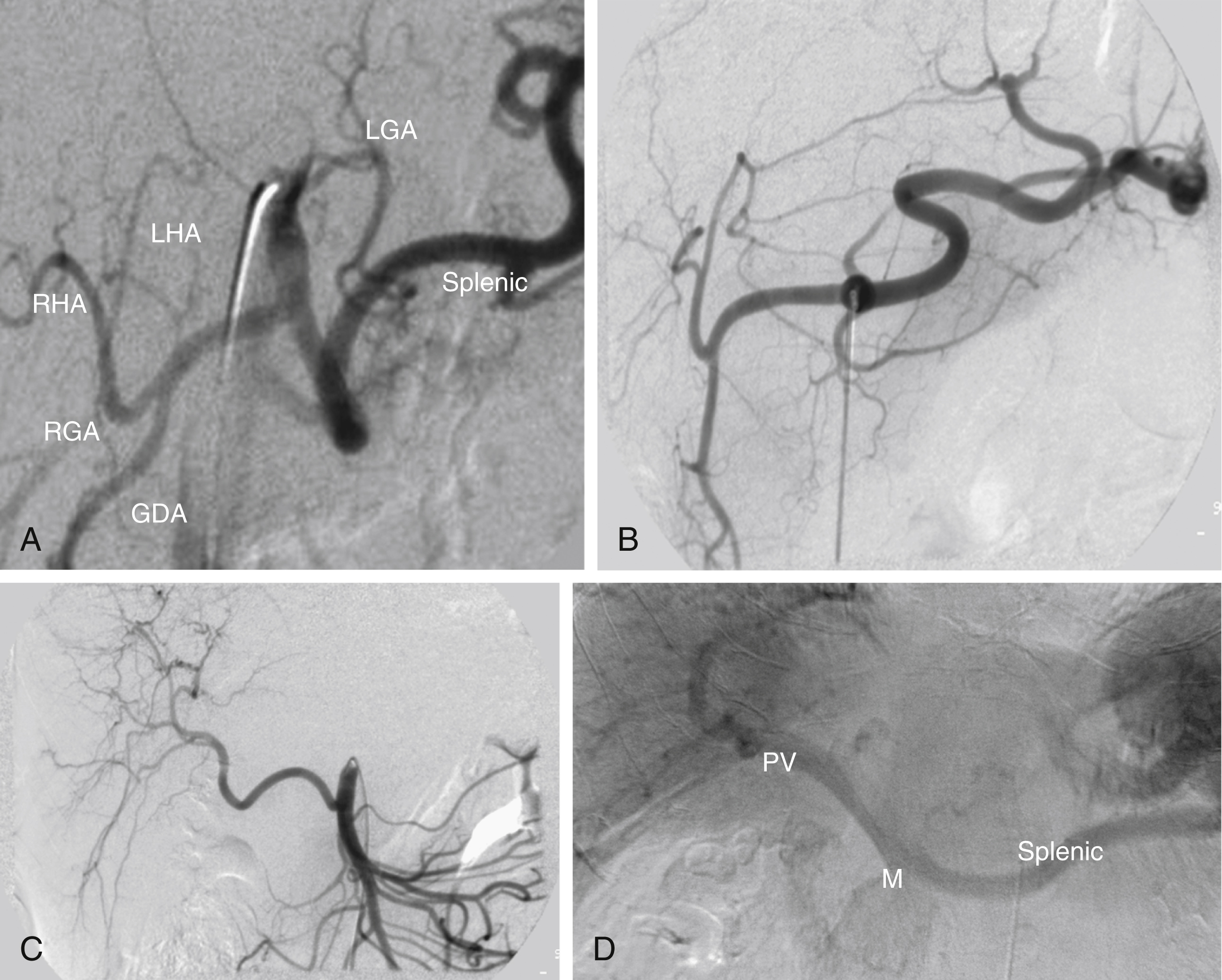 Fig. 36.1, (A) Celiac arteriogram demonstrating normal anatomy. (B) Celiac arteriogram showing that common hepatic artery divides into left hepatic and gastroduodenal arteries. The right hepatic artery is not seen. (C) Superior mesenteric arteriogram in same patient as in B shows a replaced right hepatic artery. (D) Arterial portography. Delayed filming during arteriography (catheter tip in splenic artery) shows portal vein. GDA, gastroduodenal artery; LGA, left gastric artery; LHA, left hepatic artery; M, superior mesenteric vein; PV, portal vein; RGA, right gastric artery; RHA, right hepatic artery.