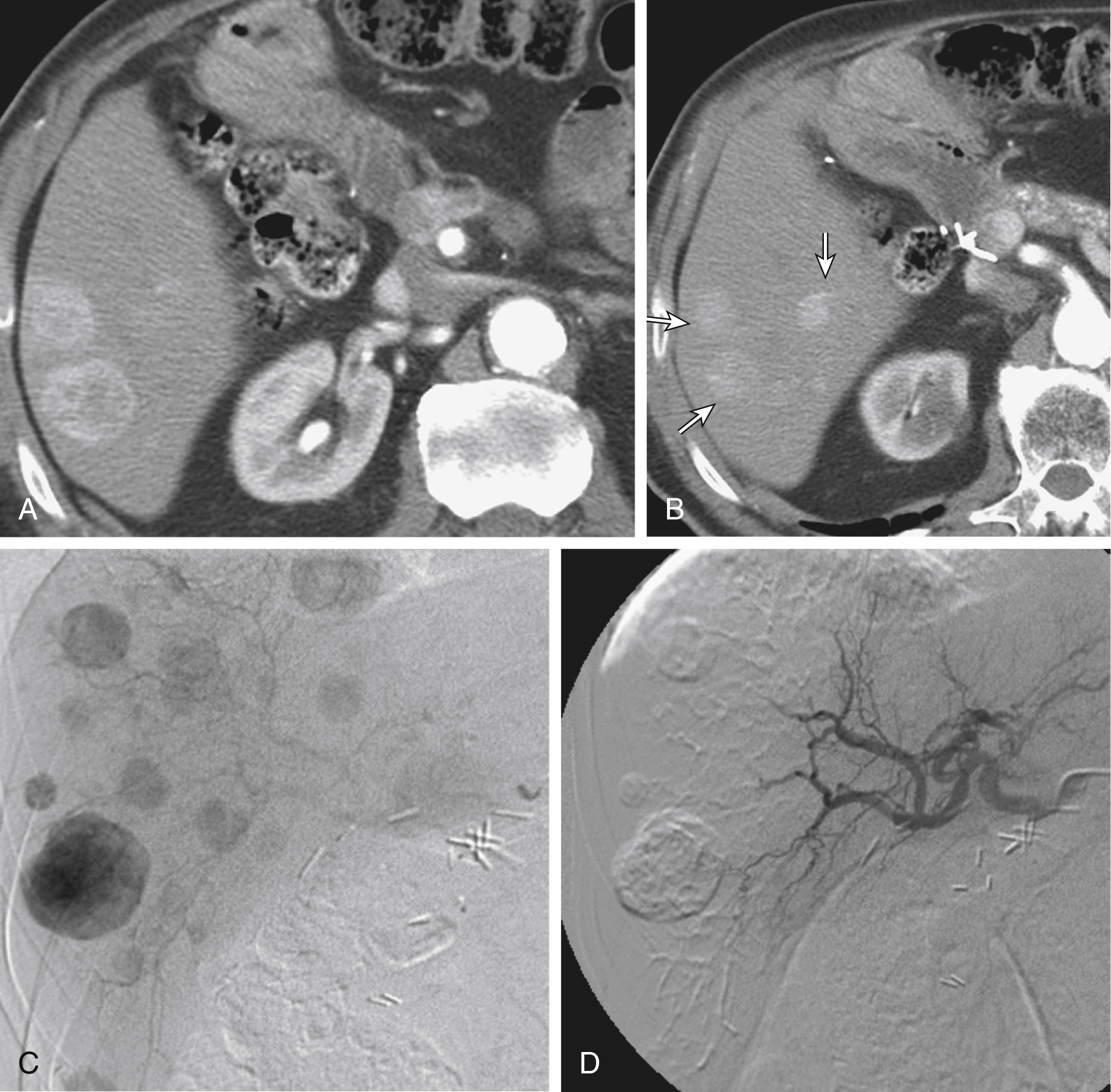 Fig. 36.2, (A)–(B) Arterial-phase computed tomography slices through liver of a patient with metastatic neuroendocrine tumor show multiple hypervascular masses ( arrows ). (C) In same patient, delayed phase of catheter arteriography (catheter tip in common hepatic artery) shows numerous hypervascular masses throughout both liver lobes. (D) After particle embolization of the right hepatic artery, arteriography demonstrates stasis in right hepatic artery and branches, with characteristic “pruned tree” appearance, and retained contrast in the embolized tumors. Left hepatic artery remains patent.