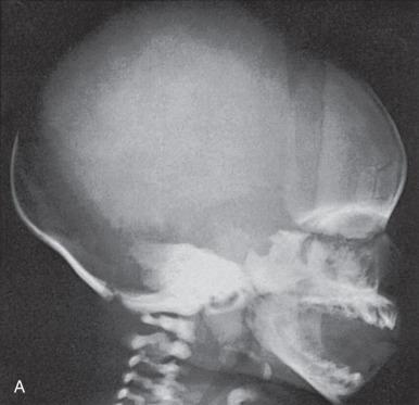 Figure 18.2, (A) Lateral radiograph of the normal neonatal skull. (B) Corresponding schematic of (A). a, Frontal bone; b, parietal bone; c, squamous portion of the occipital bone; d, exoccipital portion of the occipital bone; e, superimposed petrous pyramids of the temporal bone; f, body of the sphenoid; g, upper maxilla; h, mandible; i, partially mineralized deciduous teeth and dental crypts; j, nasal bone; k, squamosa of the frontal bone; l, horizontal plates of the frontal bone; m, squamosa of the temporal bone; o, orbit; p, pituitary fossa; 1, frontonasal suture; 2, anterior fontanelle; 3, posterior fontanelle; 4, lambdoid suture; 5, posterolateral fontanelle; 6, squamosal suture; 7, anterolateral fontanelle; 8, coronal suture; 9, synchondrosis between exoccipital and supraoccipital portions of the occipital bone; 10, mendosal suture; 11, multiple ossification centers (wormian bones) in the lambdoid suture; 12, occipitosphenoid synchondrosis.