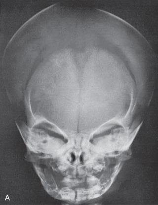 Figure 18.3, (A) Posteroanterior radiograph of the normal skull. (B) Corresponding schematic of (A). a, Frontal bone; b, parietal bone; e, superimposed petrous pyramids of the temporal bone; h, mandible; i, partially mineralized deciduous teeth and dental crypts; o, orbit; x, nasal septum; 1, frontonasal suture; 2, anterior fontanelle; 6, squamosal suture; 8, coronal suture; 13, sagittal suture; 14, metopic suture dividing the frontal bone; 19, symphysis of the mandible.