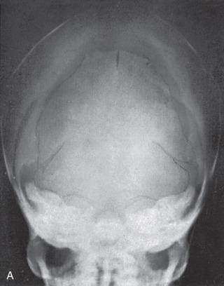 Figure 18.4, (A) Towne's radiograph of the normal neonatal skull. (B) Corresponding schematic of (A). b, Parietal bone; c, squamous portion of the occipital bone; d, exoccipital portion of the occipital bone; e, superimposed petrous pyramids of the temporal bone; f, body of the sphenoid; g, basioccipital portion of the occipital bone; h, mandible; 3, posterior fontanelle; 4, lambdoid suture; 5, posterolateral fontanelle; 9, synchondrosis between exoccipital and supraoccipital portions of the occipital bone; 10, mendosal suture; 13, sagittal suture; 15, zygomatic arch; 16, superior median fissure of the occipital bone; 17, interparietal portion of the occipital bone; 18, supraoccipital portion of the occipital bone.