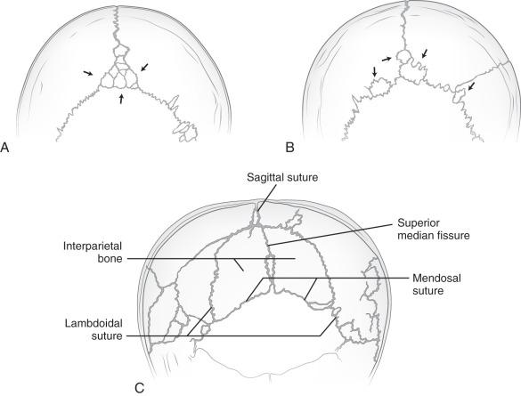 Figure 18.6, Schematics of wormian bones.