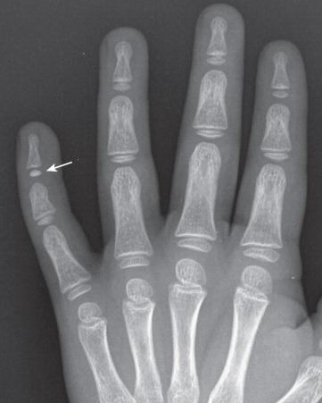 e-Figure 128.11, Ivory epiphysis (arrow) of the distal phalanx in a 6-year-old boy.