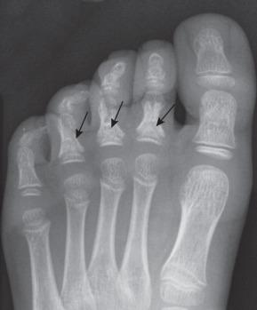 Figure 128.13, Symmetric conical or bell-shaped epiphyseal ossification centers (arrows) in the proximal phalanges of the second, third, and fourth toes of an asymptomatic 5-year-old girl.